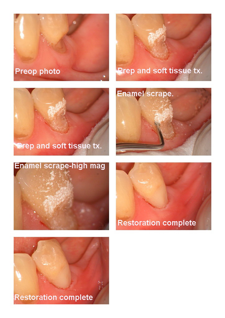 Class V with soft tissue removed.jpg